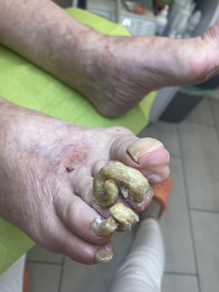 opracowanie paznokci zmienionych chorobowo przed