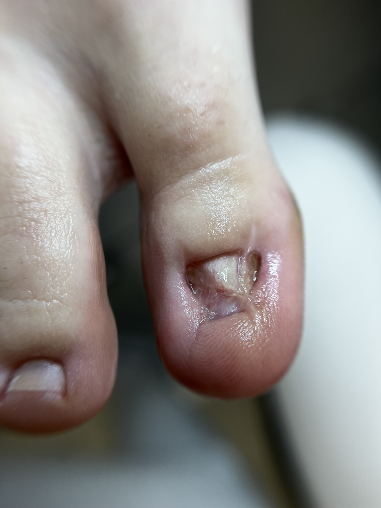 rekonstrukcja paznokcia przed