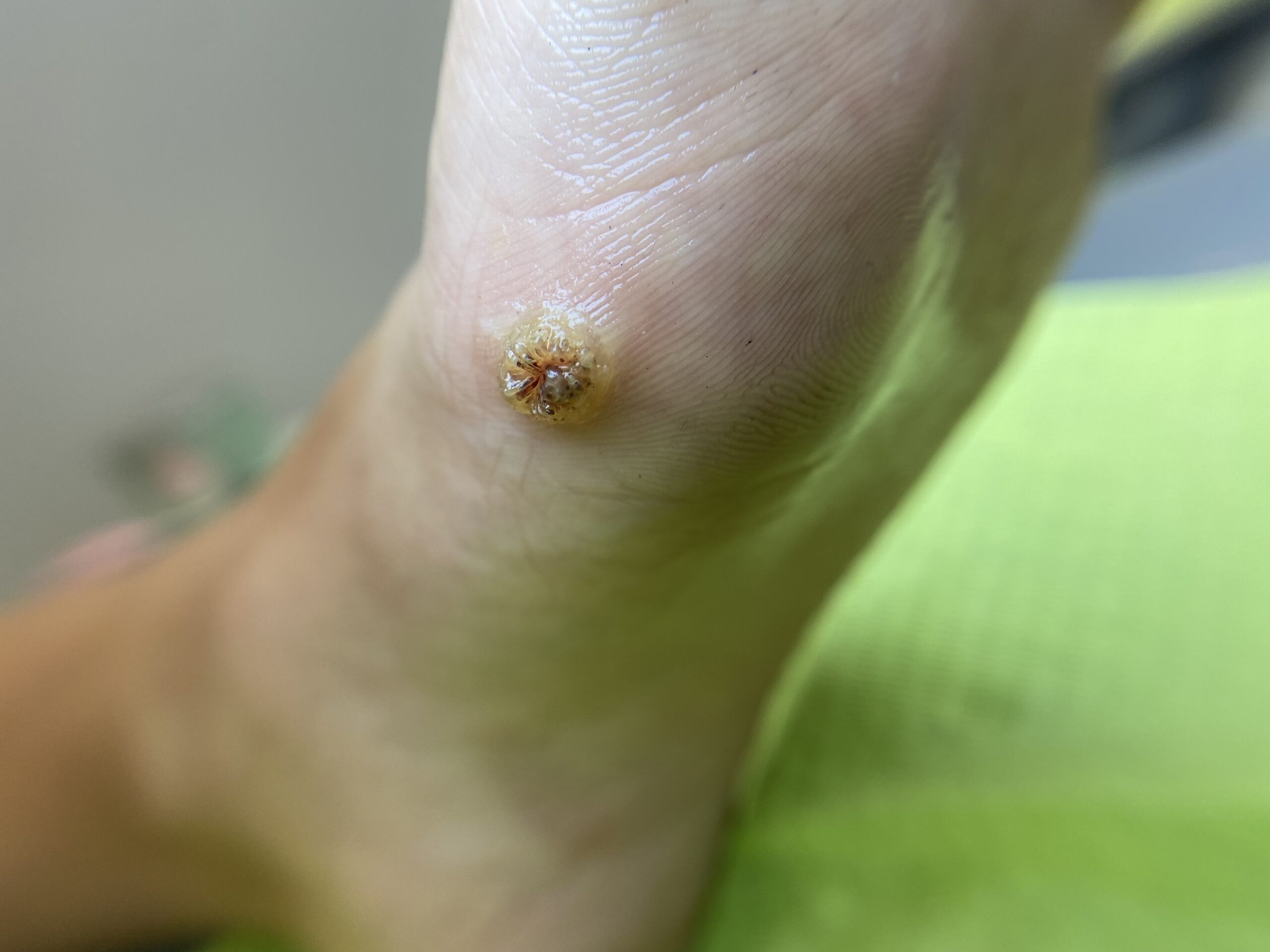 terapia brodawki wirusowej 1 wizyta scaled