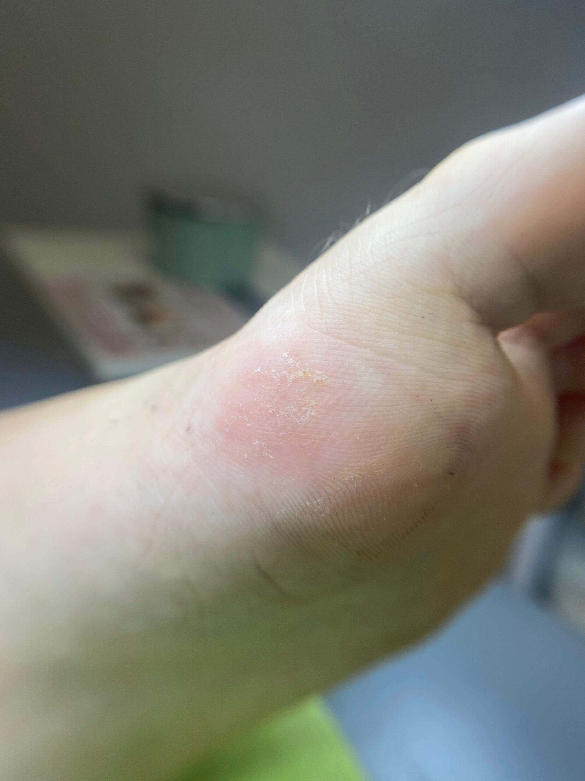 terapie brodawki wirusowej ostatnia wizyta scaled